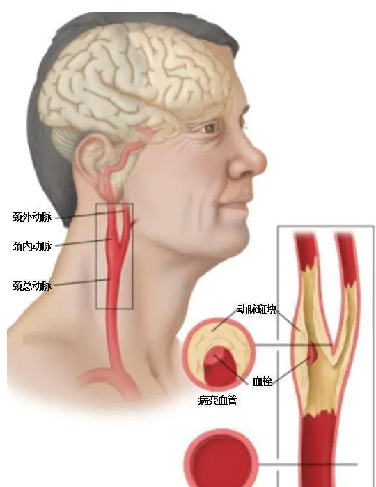 “最新頸動脈斑塊治療策略”,最新頸動脈斑塊治療策略，科技重塑健康，引領(lǐng)生活新風(fēng)尚