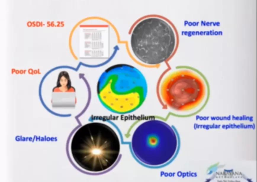 圓錐角膜最新治療及步驟指南