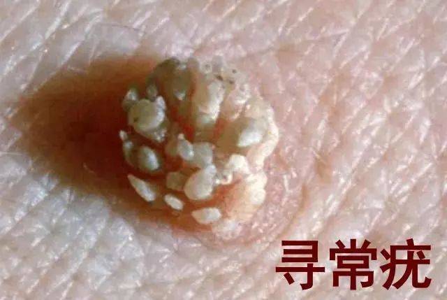 生殖疣最新治療技術，自然美景下的心靈康復之旅